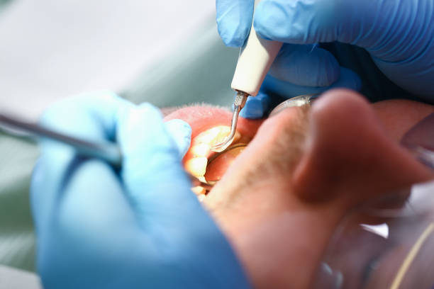 Best Dentist for Tooth Abscess  in Buena Vista, VA
